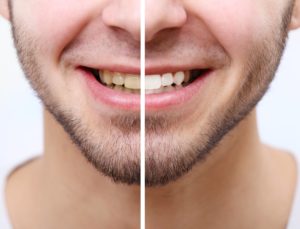 Man before and after teeth whitening procedure