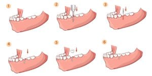 Dental implant procedure steps