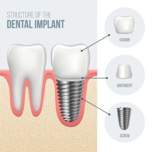 Parts of a dental implant
