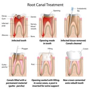 Steps of a root canal