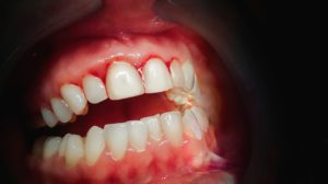 Close up of inflamed, bleeding gums