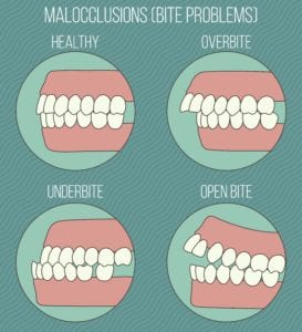 Types of Malocclusion 
