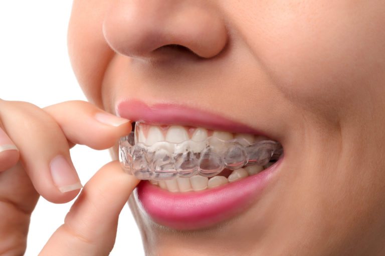 Invisalign in patients mouth