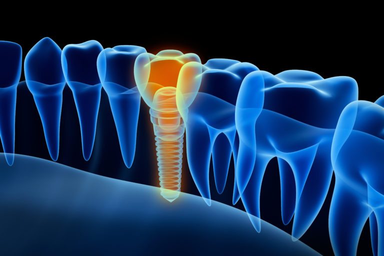 Dental Implants: Restoring A Natural Beauty To Your Smile