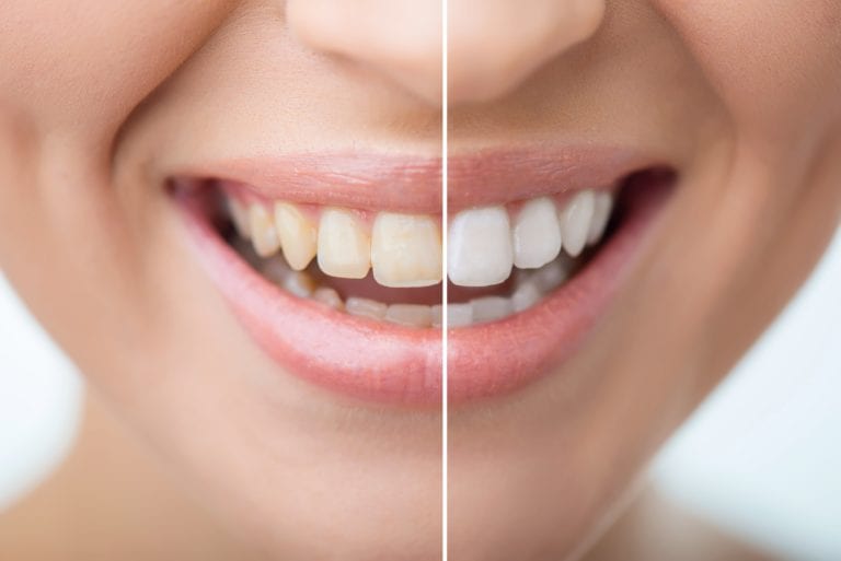 Cosmetic Dentistry: More Than vanity, It's About Continuing Dental Health