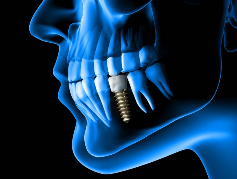 What Considerations Are There For Implant Dentistry?