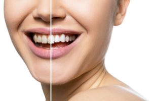 5 Reasons Why You Should Get Your Teeth Whitened