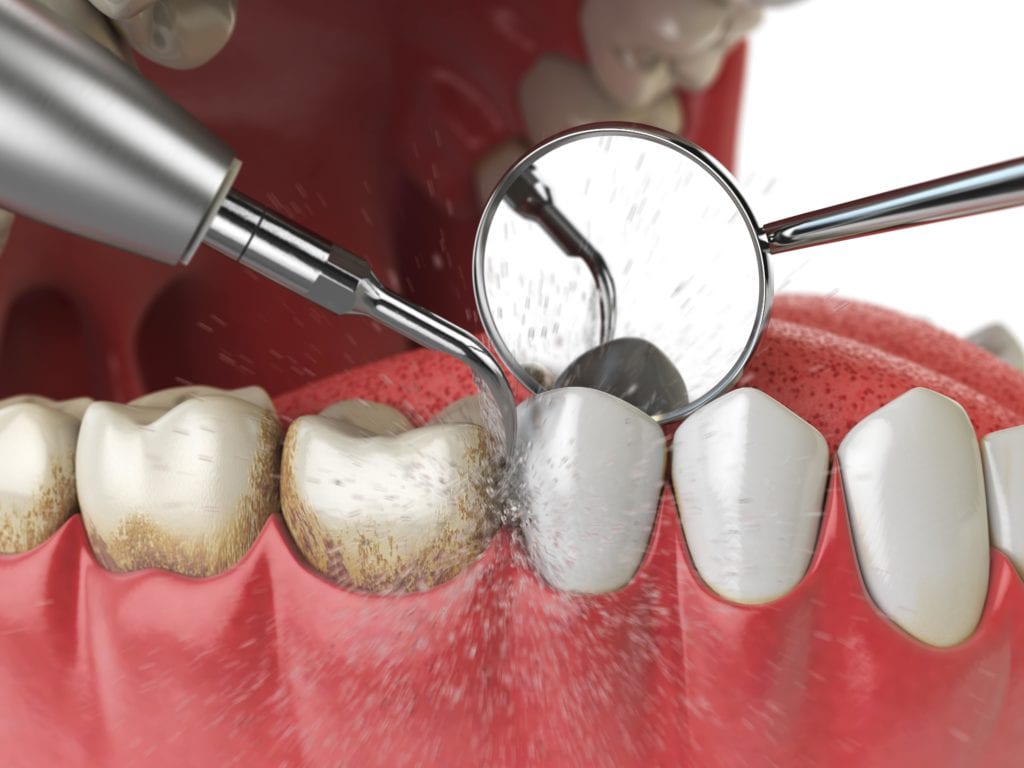 Dental Implants Newberry Fl