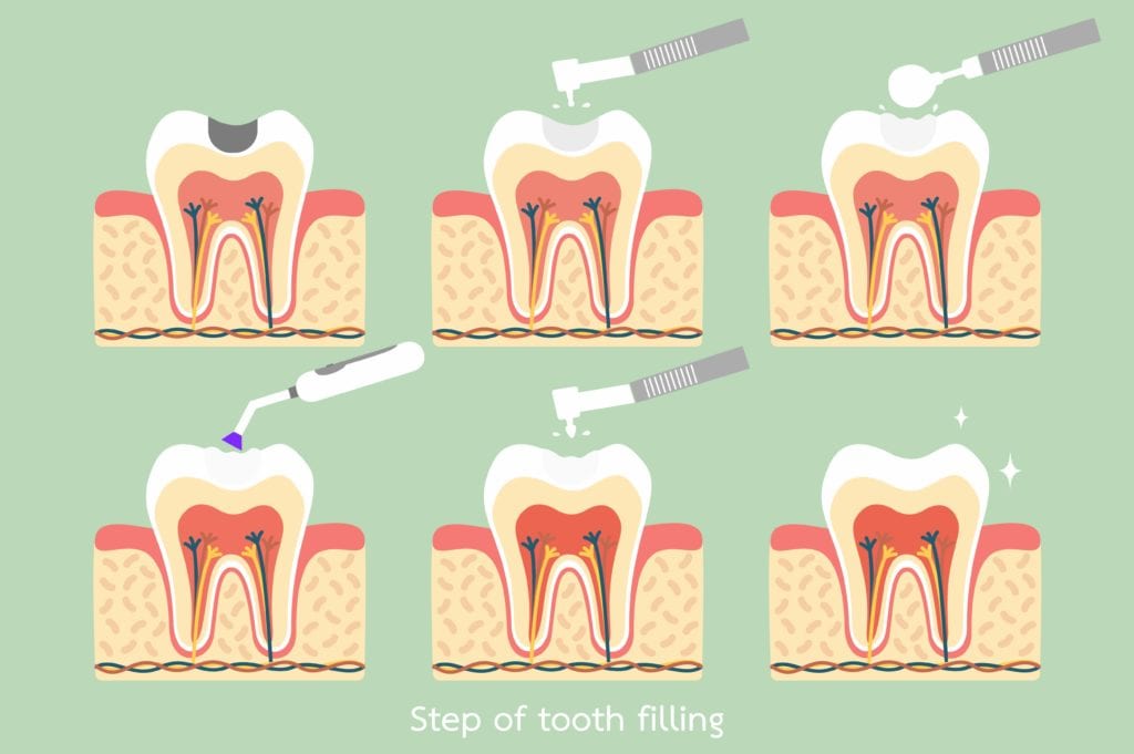 Diagram showing the steps of a dental filling
