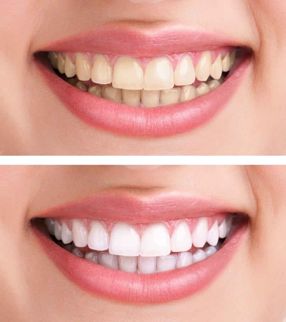 Transforming Smiles: Cosmetic Dental Treatments