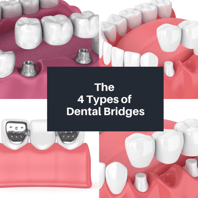 the four types of dental bridges