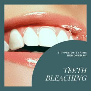 5 types of stains removed by teeth bleaching