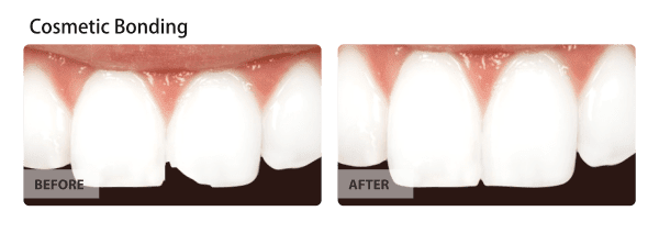 Cosmetic Bonding - For a Great Smile with Cosmetic Bonding