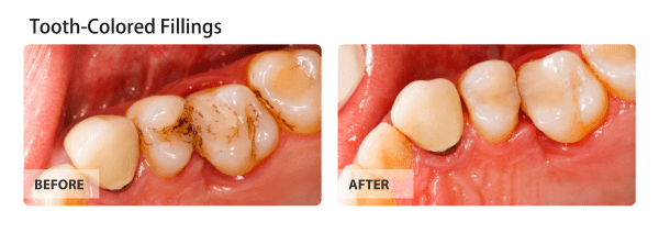 Tooth-Colored Fillings - For a Smile without any Metal fillings