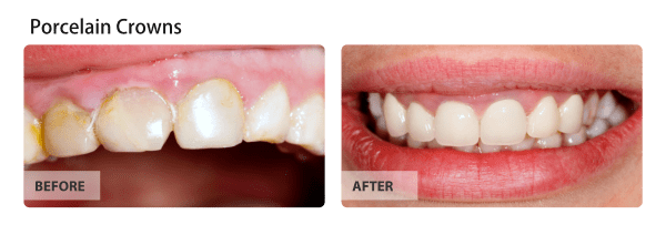 Porcelain Crowns - For a Perfect Smile with Porcelain Crowns