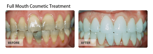 Full Mouth Cosmetic Treatment - For the Best Smile Anyone would be Proud of.