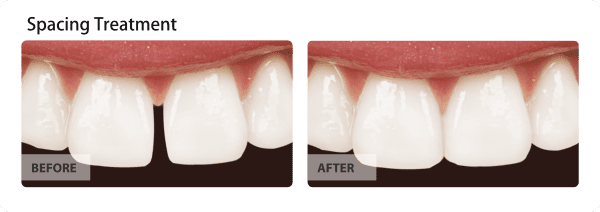 Spacing Treatment - A Smile the way you want it without any gaps