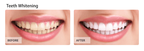 Teeth Whitening - For the Brightest Smile