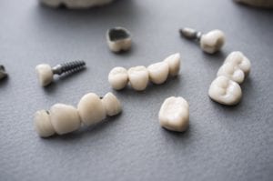 Dental implant pieces
