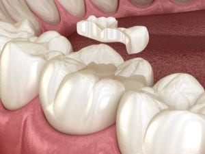 How Long Does a Cavity Filling Take
