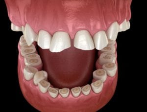 teeth worn from bruxism