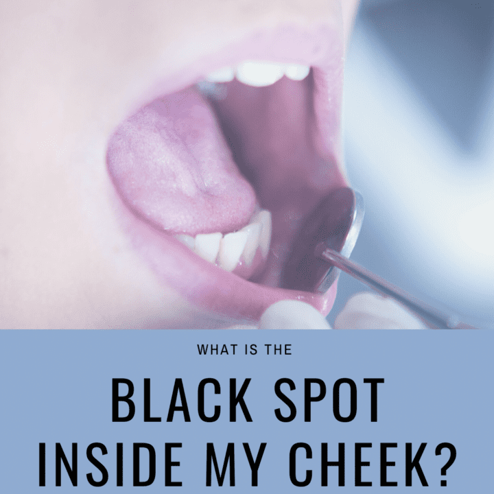 what-is-the-black-spot-on-the-inside-of-my-cheek