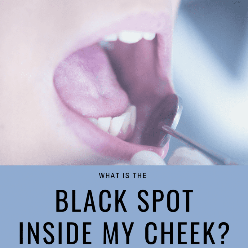 What Does A Black Spot On The Inside Of Your Cheek Mean