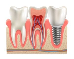 dental implant next to real teeth