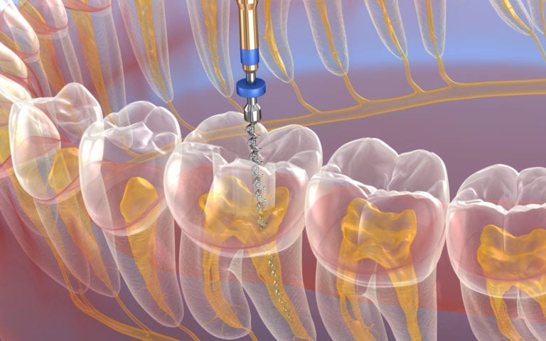 Rendering of Root Canal