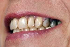 teeth stained by metal fillings
