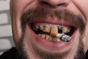 man with disgusting stained teeth from smoking