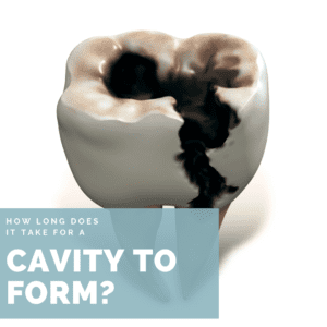 How Long Does it Take for a Cavity to Form?
