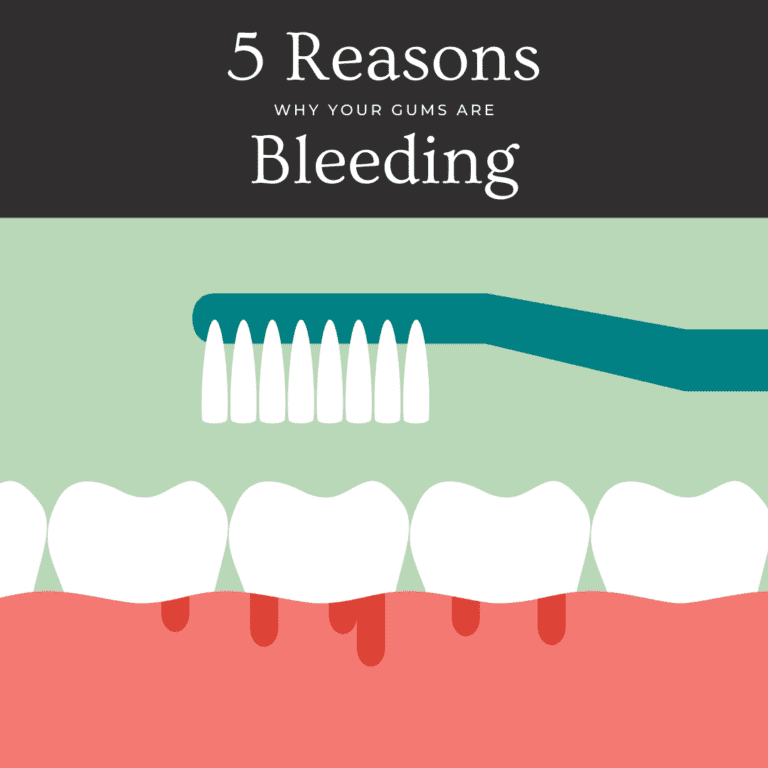 5 Reasons Why Your Gums Are Bleeding