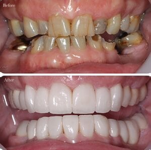 decayed teeth before and after dental crowns