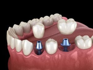 dental implants in jaw