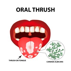oral thrush on tongue