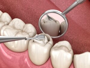 filling a cavity with composite resin