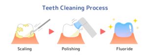dental cleaning process