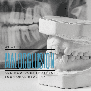 What is Malocclusion and How Does it Affect Your Oral Health?
