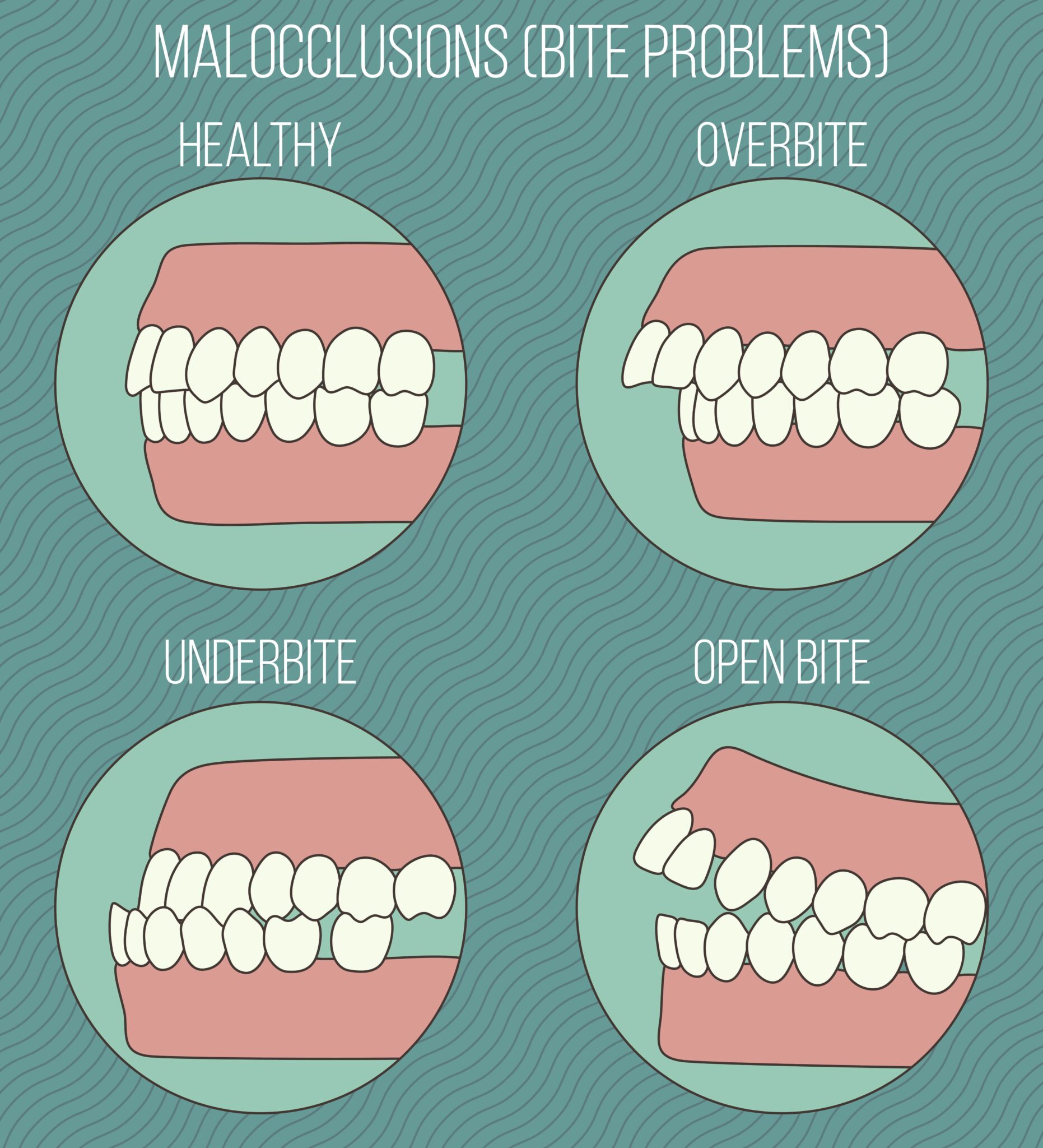 what-is-malocclusion-and-how-does-it-affect-your-oral-health