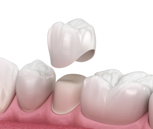 Porcelain Crowns - giving you a stronger and better looking smile