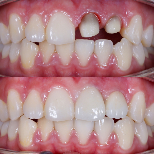 Porcelain Crowns - the process of getting porcelain crowns so you know what you can expect
