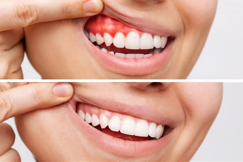 Gum Disease Treatment - Bethesda helps with preventing gum disease