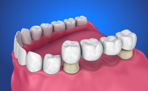 Restorative Dentistry - another restorative procedure is dental bridges