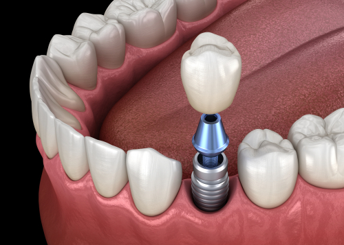 Restorative Dentistry - Dental Implants is another type of restorative procedure