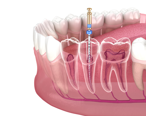 Restorative Dentistry - to help with such problems as endodontics for treating tooth pain