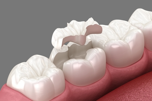 Restorative Dentistry - Inlays and Onlays