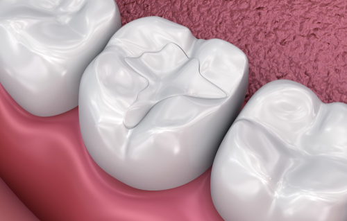 Restorative Dentistry - get composite tooth color filling for an even better smile
