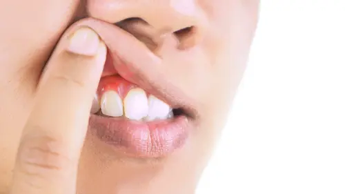 Dental Abscess Symptoms - Bethesda Family Dentistry