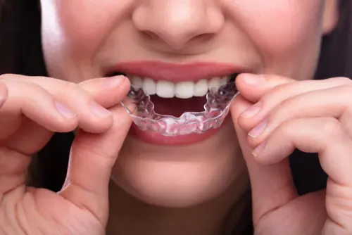 The Many Benefits of a Night Guard for Bruxism - Bethesda Family Dentistry